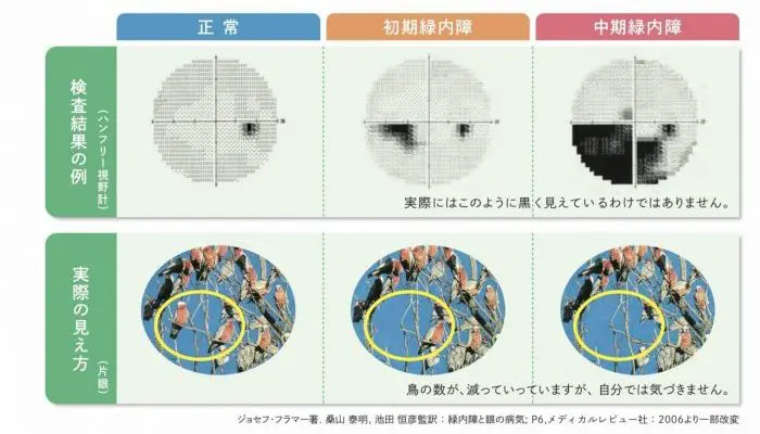 OCT検査 緑内障 | 錦糸町眼科